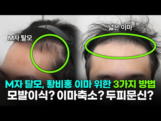 모발이식 VS 이마축소 VS 두피문신 뭐가 더 좋을까? 장단점 총정리[ENG CN JP SUB]