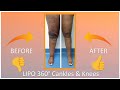 Cankles & Knees | Liposuction Results | Lipo 360° | Expert Dr. Thomas Su