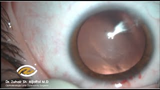 Cataract surgery: soft lens (steroid induced PSCC)