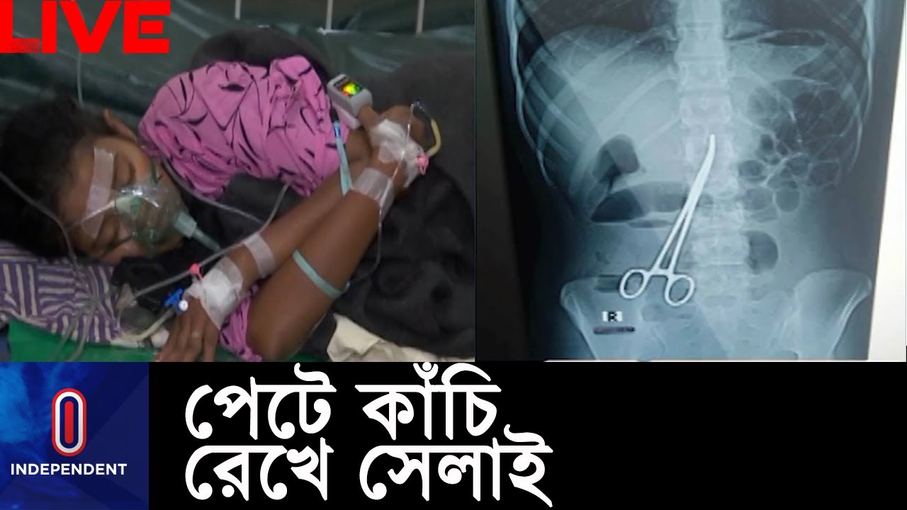 ২ বছর পর বের করা হল রোগীর পেটে থাকা সেই কাঁচি ।। Patient Suffering