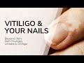 Nail Changes You Should Never Ignore: The Vitiligo Connection