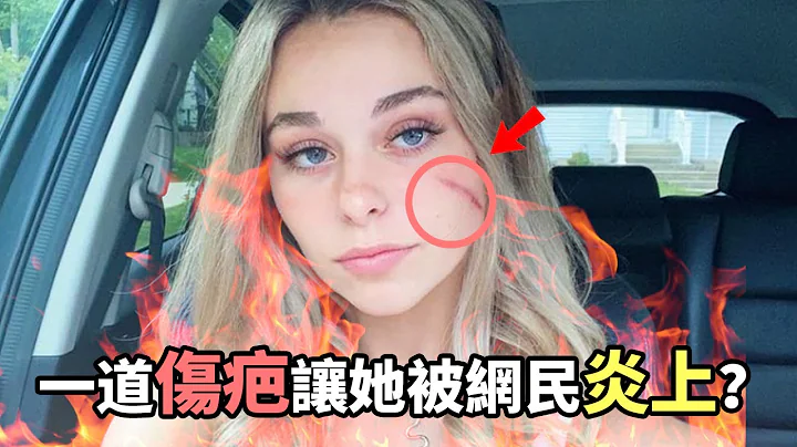一道傷疤讓她一夜爆紅？這個神秘的女大學生為何讓歐美網友們吵了大半個月！ - 天天要聞
