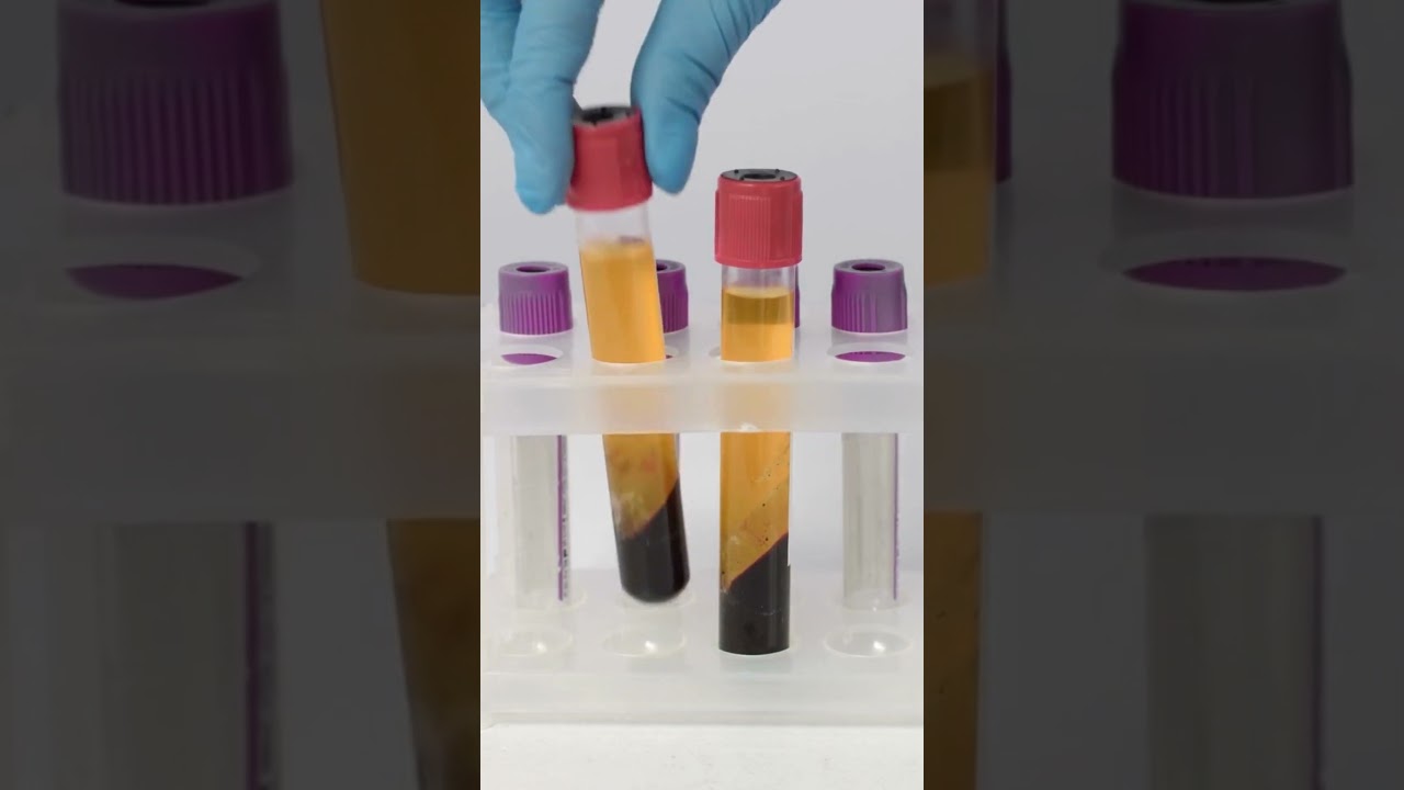 Knee pains-What is PRP (plasma) injection? 