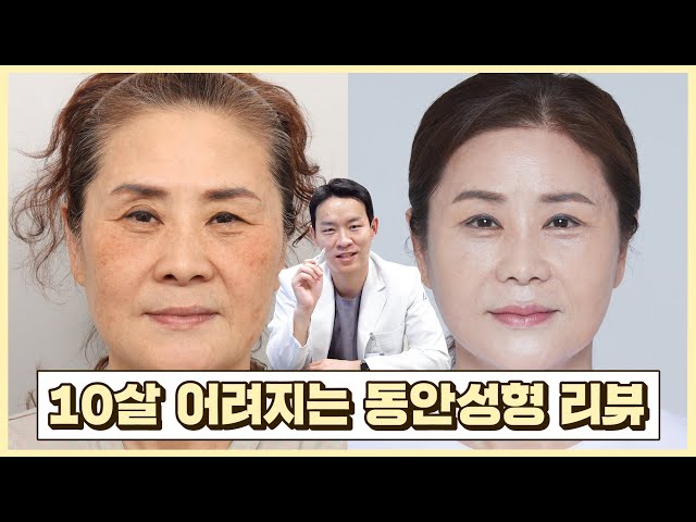 실제 사례로 보는 동안성형 리뷰│미니거상│이마축소│상안검│이마거상술│지방이식│에이비성형외과