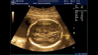 case of the week 17 trisomy 18