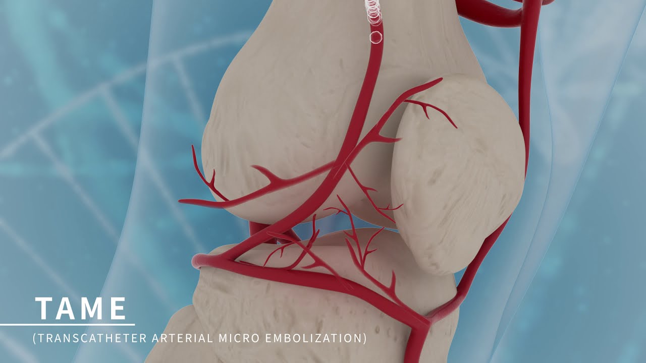 TAME : Transcatheter Arterial Micro Embolization(Smart-Gel, PL micromed)