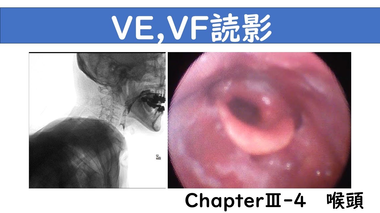 声門閉鎖不全原因 _ 声帯の動きが悪い – NASLEMM