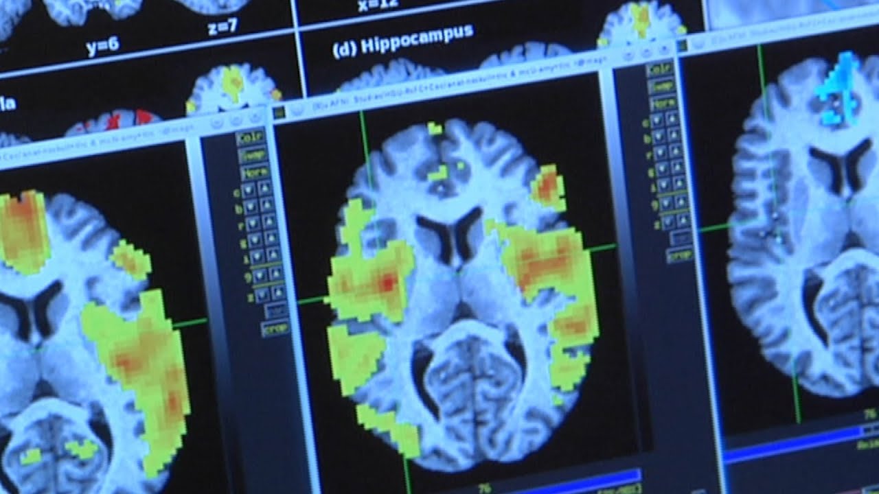 Image result for MRI of brain of shabu drug addict
