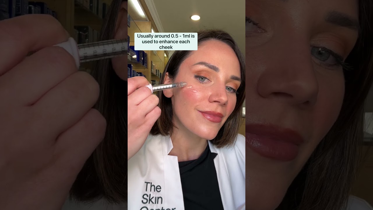 How much cheek filler is used in the cheeks? 💉