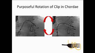 Should I Move This Clip? - Sameer Gafoor, Md