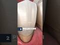 Металлокерамические коронки❌