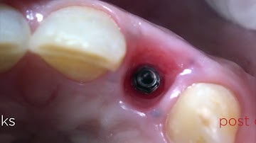 Custom Cervical Profile development for a lateral incisor