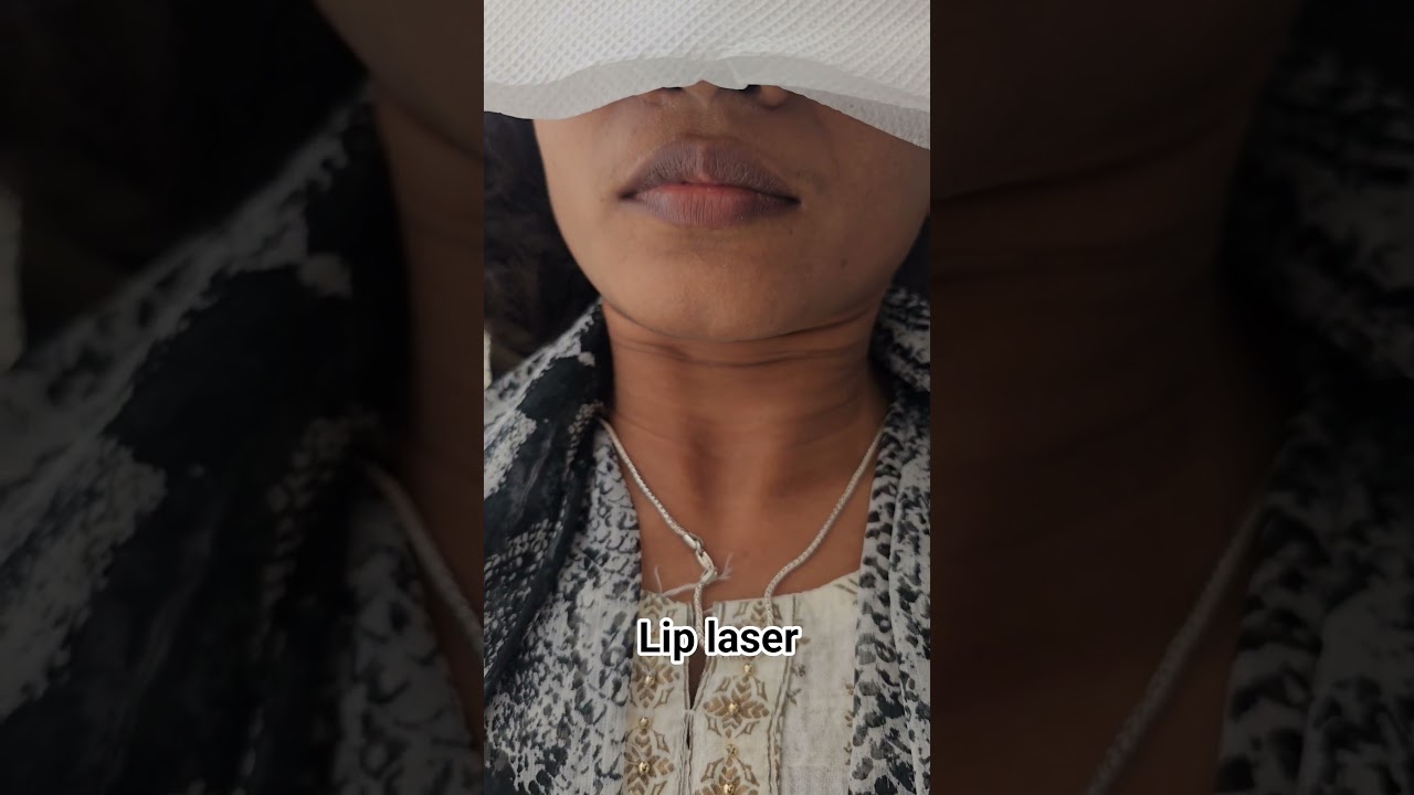 lip laser for pigmented lips‎⁨@NEWMEECosmetology⁩               Call:89713 60607   Hebbal ,Bangalore