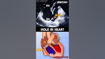 Atrial Septal Defect (ASD) Hole in Heart (2DEcho vs Animation) #shorts #asd #echocardiography