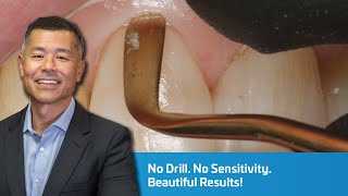 No Drill. No Sensitivity. Beautiful Results: Class V Restoration Game-Changer! | Dentist 2 Dentist