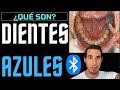 ¿Por qué tiene los DIENTES AZULES? Levantes de mordida en ORTODONCIA