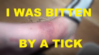 I was bitten by a Tick