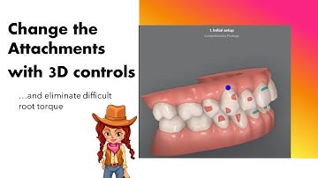 Invisalign ClinCheck - Changing attachments with 3D controls