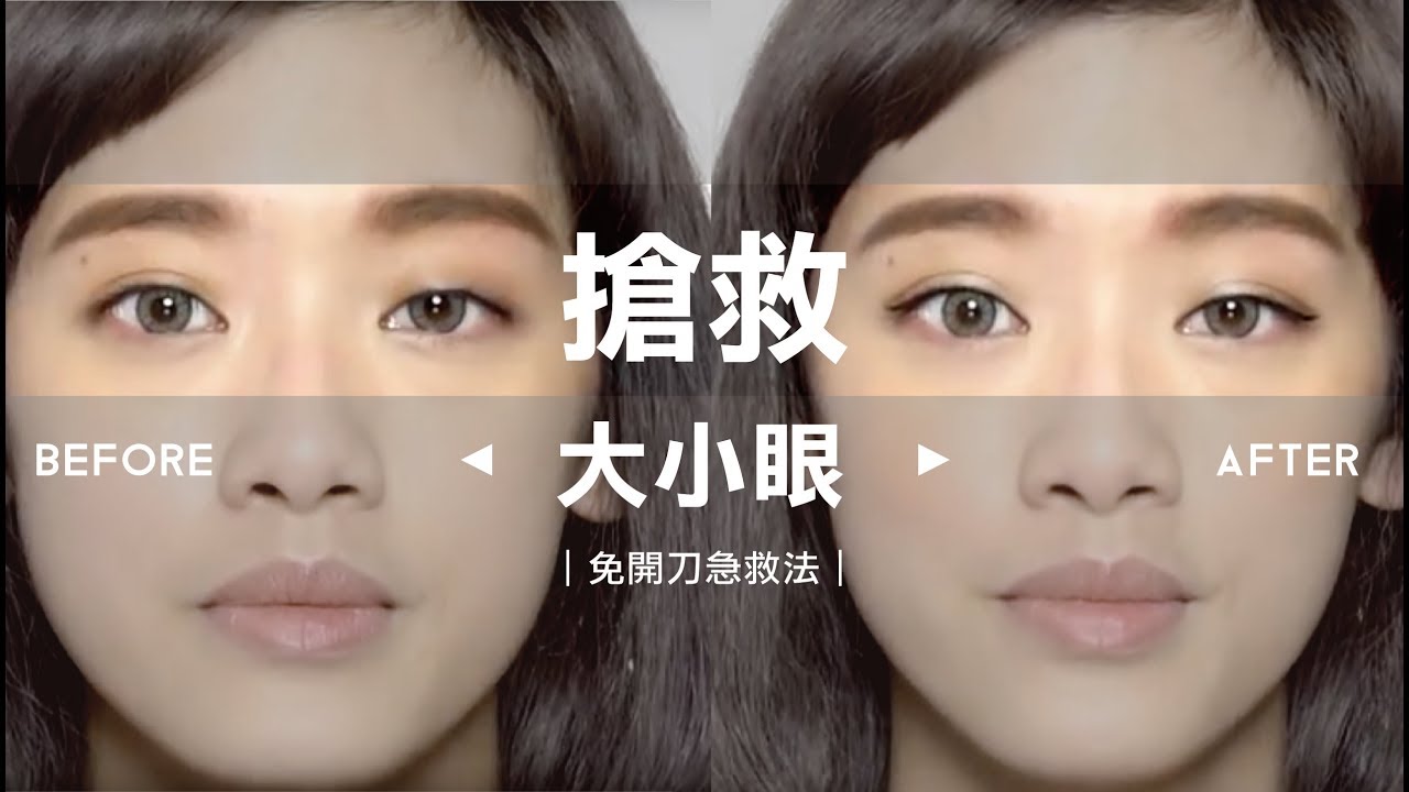 凱咪急診室 免開刀的大小眼急救法 Youtube