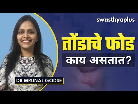 तोंडाचे फोड नेमके काय असतात? | Mouth Ulcers/ Mouth Sores in Marathi | Dr Mrunal Godse