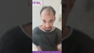 من نتائجنا الحديثة في عمليات زراعة الشعر . أستعد شعرك الصحي معنا . @HMC_Beauty