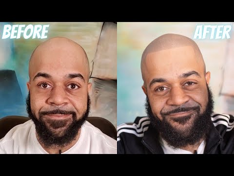 Come stop loss capelli con CUOIO micropigmentation