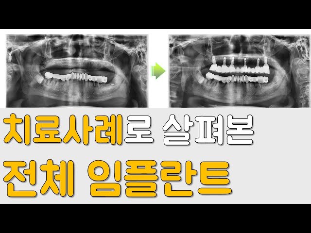 사례를 통해 살펴보는 임플란트 시술전후