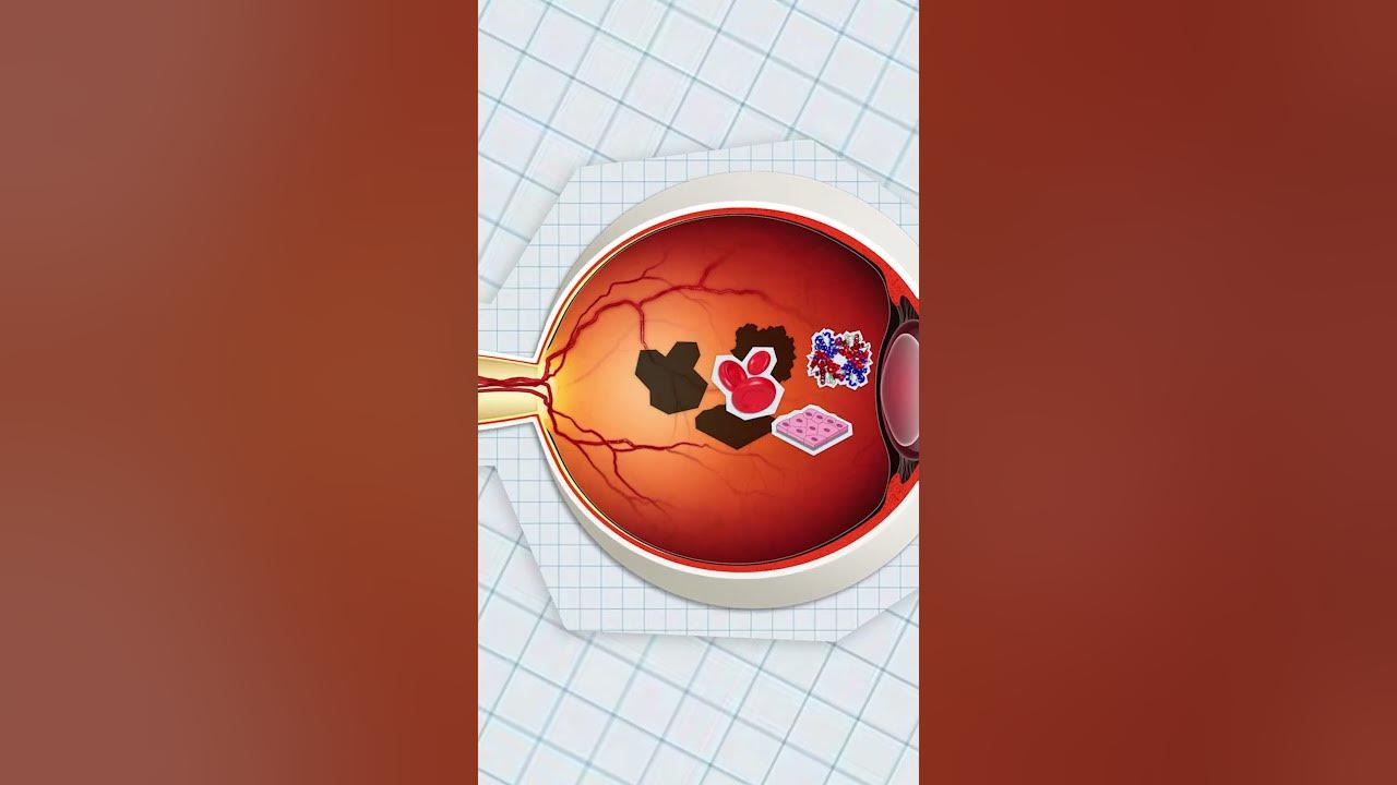 Floaty things in your eye explained youtube