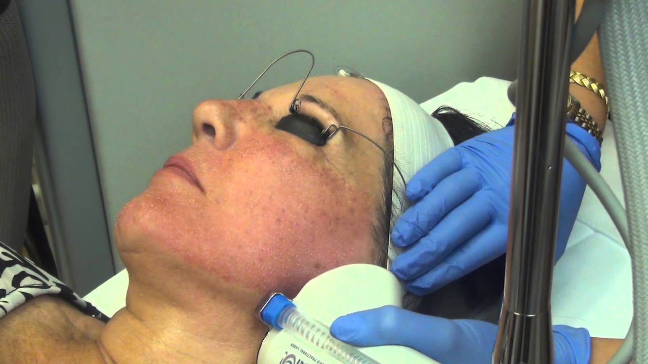 Halo™ Hybrid Fractional Laser at La Jolla Cosmetic Surgery Center