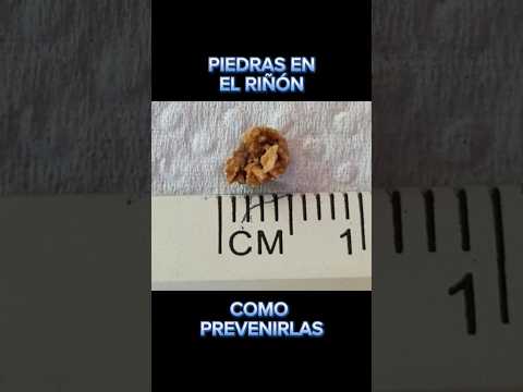 Cálculos renales (piedras en el riñón) cómo prevenirlos ✅ #medicina #educación