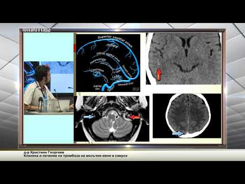 Клиника и лечение на тромбоза на мозъчни вени и синуси