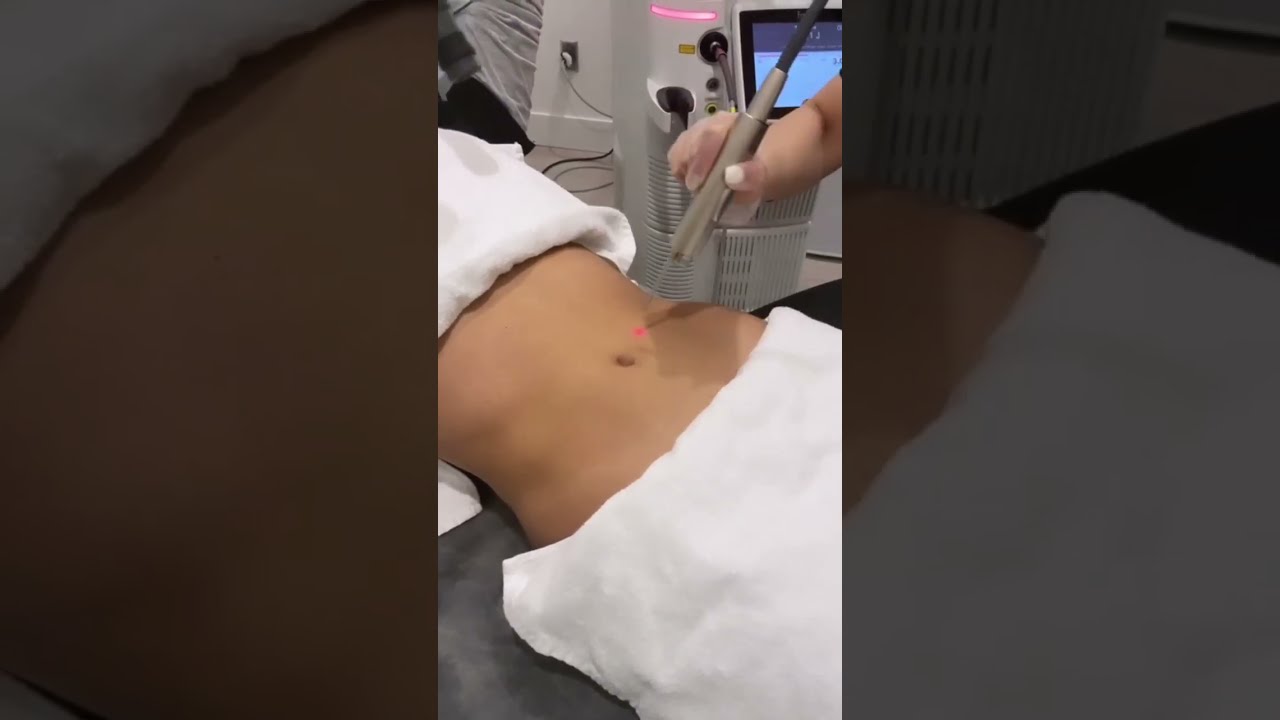 TightSculpting is a non-invasive laser treatment for sculpting and skin tightening on all body areas