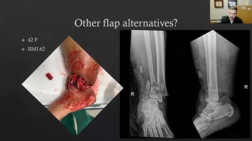 Workhorse Flaps of the Lower Extremity, James Blair, M.D. | HOGR-HUP 2025