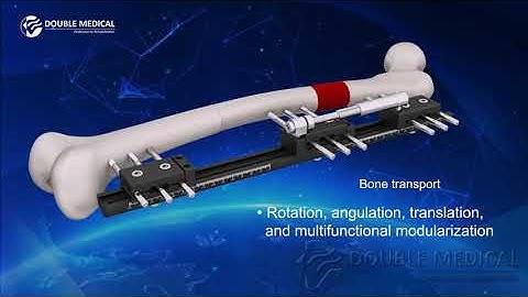 Double Medical Limb Resconstruction and Lengthening System