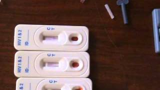 Hiv positive man doing an instant test from surehivtest.com also with
negative person. see how the gives results in 30 seconds