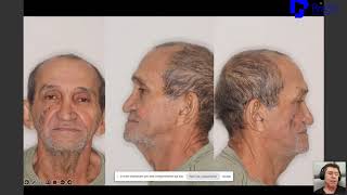 Management of a Zygomatic Implant Complication | External Access Surgical Approach