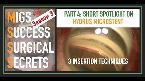MSSS-3 Hydrus: MIGS Success Surgical Secrets Spotlight on Hydrus Insertion Techniques
