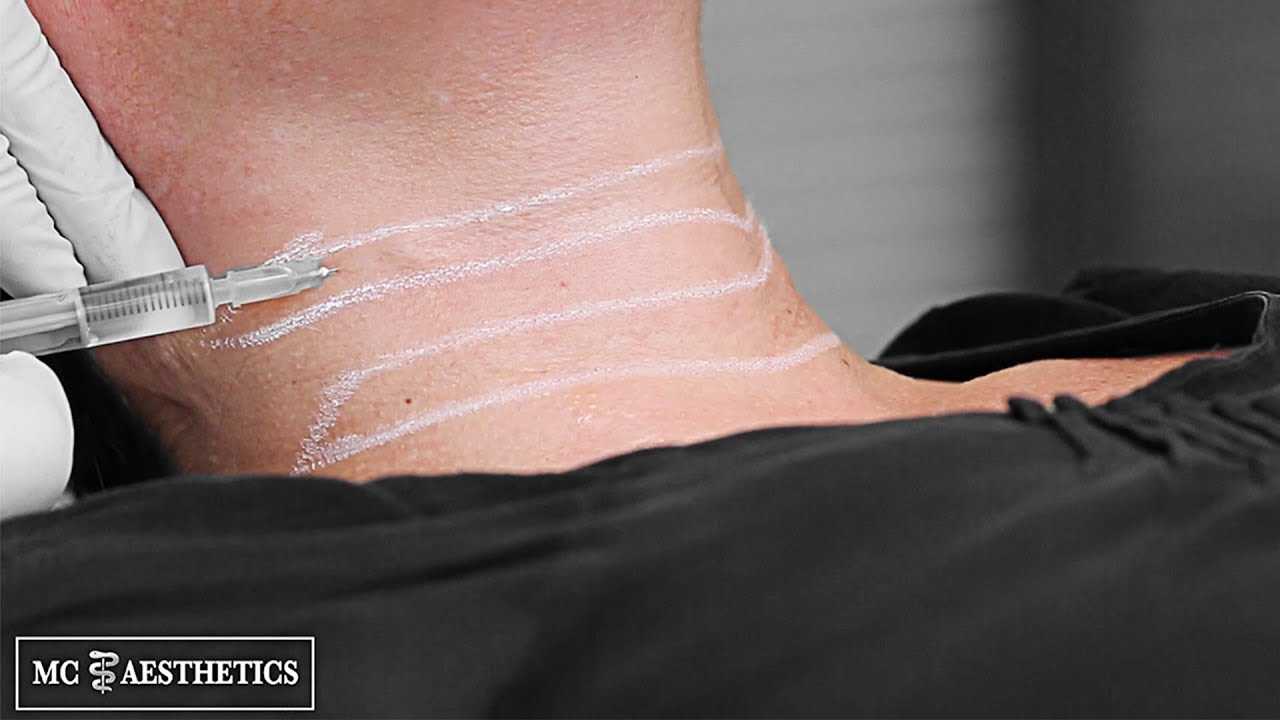 Mc Aesthetics präsentiert die Halsfalten Behandlung