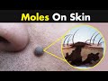 What causes moles in our skin 3d animation