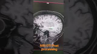 MRI DTI Post processing short video
