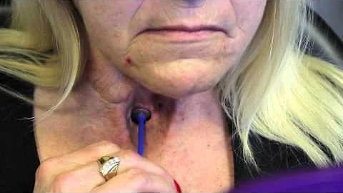 Use of Provox Brush - how to insert and use the Brush to clean a voice prosthesis (TEP)