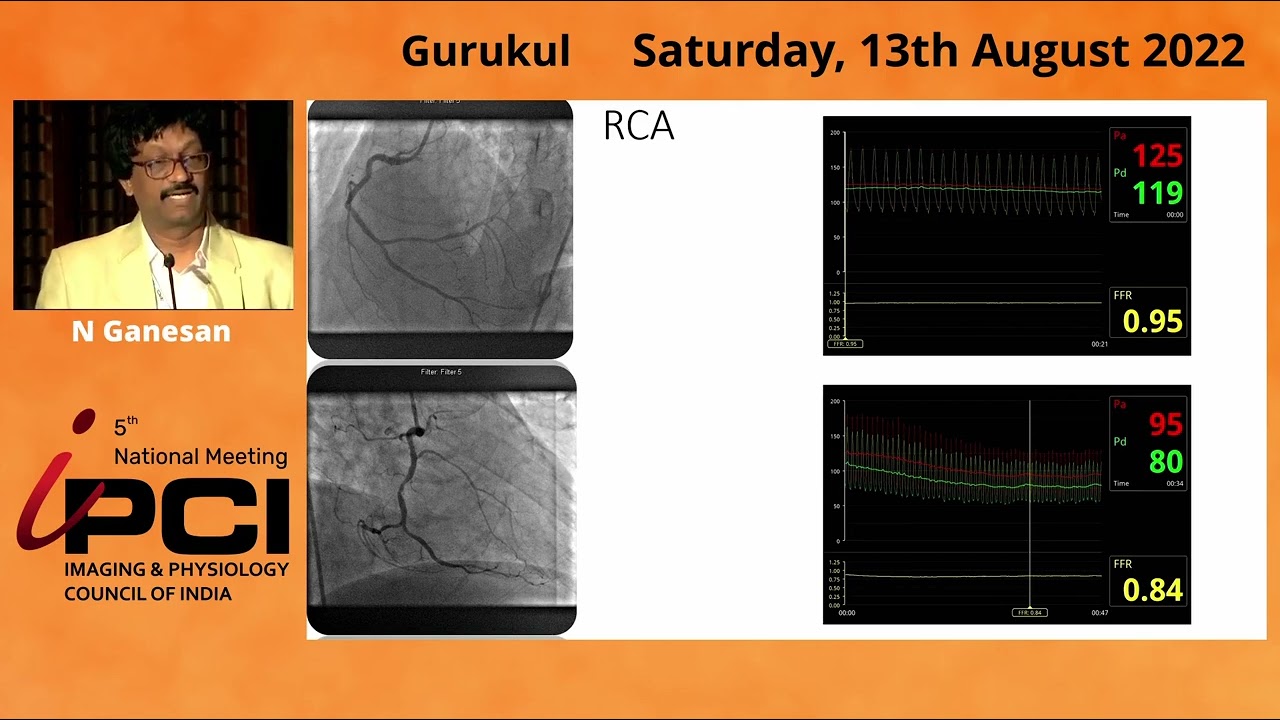 DR.N GANESAN- CABG  VS PCI VS MEDICAL MANAGEMENT