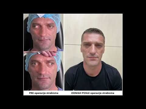 Estetska operacija strabizma sa velikim uglom devijacije na oba oka, specijalna bolnica Sveti Vid