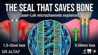 LASER-LOK IN IMPLANTS: The Microtechnology That Replaces the Tooth’s Soul: PART I