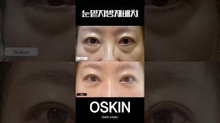 눈밑 불룩한 지방? 없애버렷슨ㄷㄷ #Shorts #눈밑지방재배치 #beforeafter