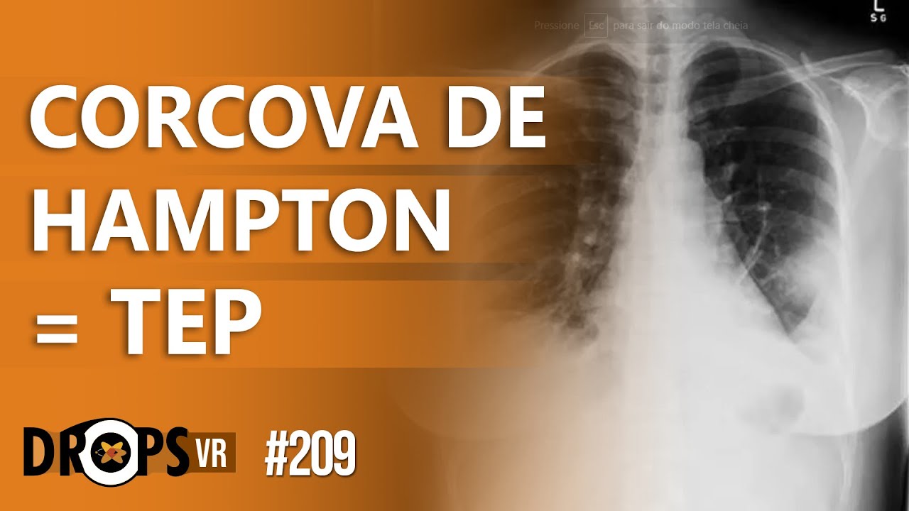 CORCOVA DE HAMPTON VOCÊ SABE IDENTIFICAR ESSE SINAL NA RADIOGRAFIA DE TÓRAX? YouTube CORCOVA DE HAMPTON VOCÊ SABE IDENTIFICAR ESSE SINAL NA RADIOGRAFIA DE TÓRAX? YouTube