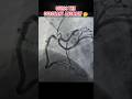 Guess the Coronary Anomaly #angiography #heart #anatomy
