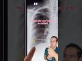 You won’t believe what’s in her lung!