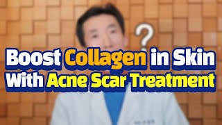 ［Scar clinic in korea］Boost collagen in skin with acne acar treatment❤️