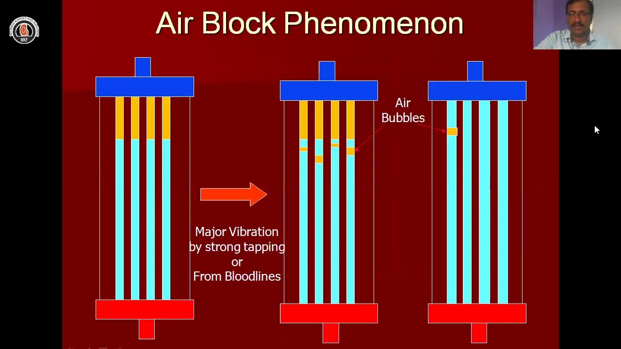 How to avoid Clot in Hemodialyzer| Mumbai Kidney Foundation | Dr Thaigarajan Thandavan
